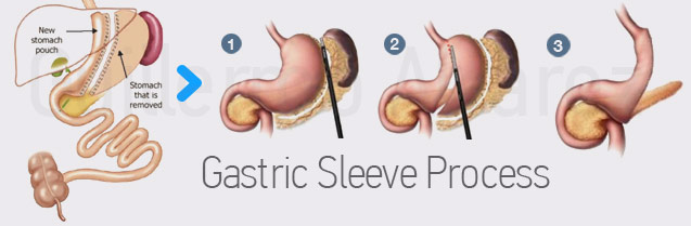 Gastric Sleeve Surgery: What is a Gastric Sleeve Procedure?